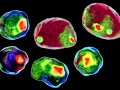 Role of Flow Cytometry and Immunology in Cancer Treatment