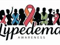 Celebrities with Lipedema: Shedding Light on a Hidden Struggle