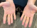 Doctor Finds Florida Man Has Cholesterol Oozing From His Body